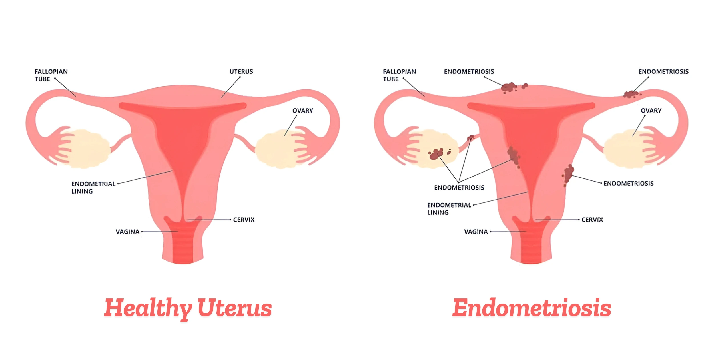 Best Endometriosis Treatment in Delhi  | Book a Consultation